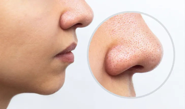7 ways to reduce the problem of large, clogged pores Come back smooth and bright.